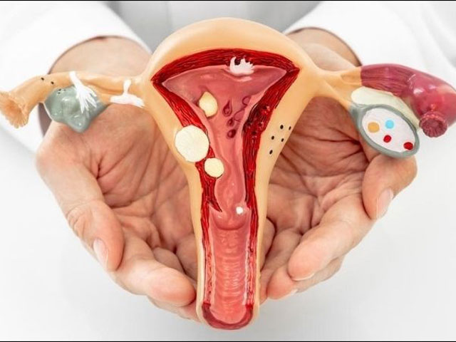 Nguyên nhân nào dẫn tới rong kinh ở phụ nữ 4 Polyp-Tử-Cung