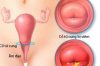 Biểu hiện viêm cổ tử cung