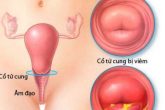 Biểu hiện viêm cổ tử cung