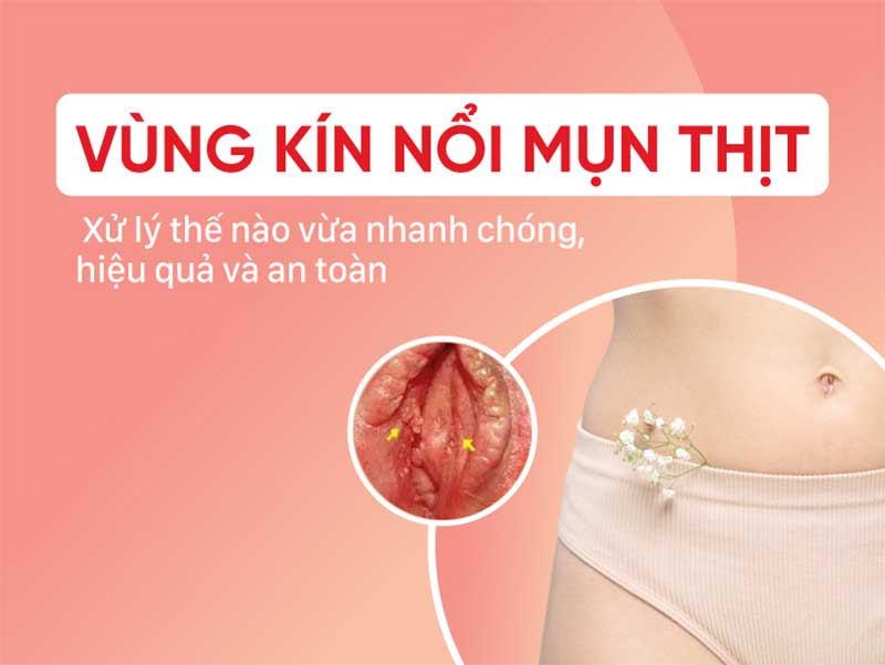 mụn vùng kín nữ