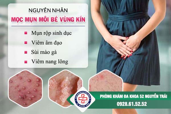 nguyên nhân mụn vùng kín