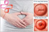 Viêm lộ tuyến cổ tử cung nguyên nhân tiềm ẩn gây ung thư cổ tử cung