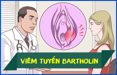 Viêm tuyến Bartholin có nguy hiểm không ? Nguyên nhân và cách điều trị