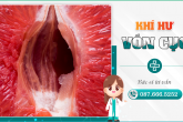 Khí hư vón cục là dấu hiệu của bệnh gì?