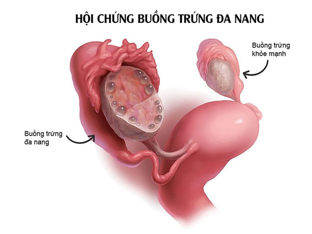 Nguyên Nhân Gây Chậm Kinh Ở Nữ Giới - Bác Sĩ Chuyên Khoa Tư Vấn Online Cách Sử Lý 4 Hội-Chứng-Buồng-Trứng-Đa-Nang