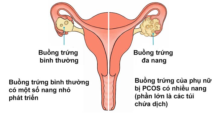 Nguyên nhân mất kinh