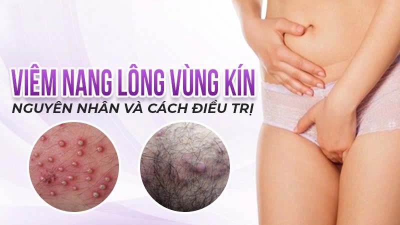 Viêm nang lông vùng kín nổi mụn ngứa – Tư vấn cách xử lý hiệu quả từ chuyên gia