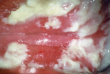 Ra Khí Hư Vón Cục Như Bã Đậu Là Dấu Hiệu Bệnh Gì? Nguy Hiểm Không? 12 dấu hiệu khí hư vón cục