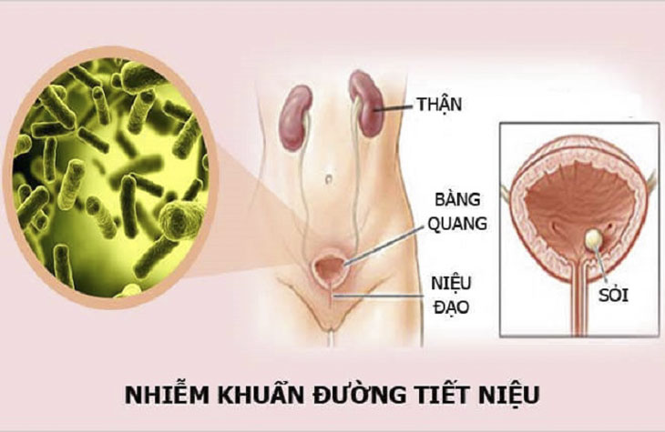 Tiểu Buốt Rát Là Dấu Hiệu Bệnh Gì? Cảnh Báo 7+ Nguyên Nhân & Cách Điều Trị Hiệu Qủa 15 nhiễm trùng đường tiết niệu