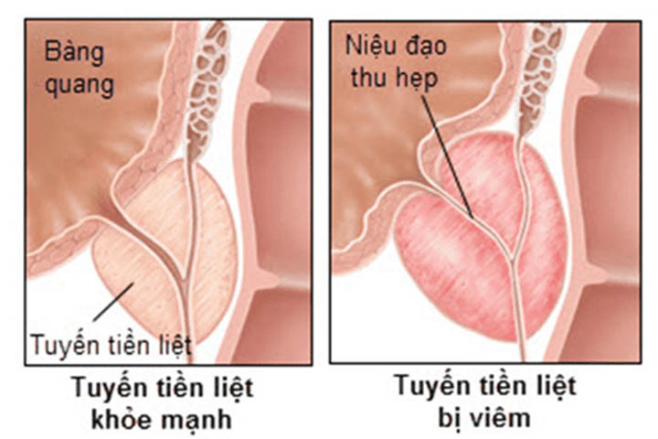 Tiểu Buốt Rát Là Dấu Hiệu Bệnh Gì? Cảnh Báo 7+ Nguyên Nhân & Cách Điều Trị Hiệu Qủa 16 viêm tuyến tiền liệt