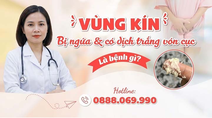 Vùng Kín Bị Ngứa Và Có Dịch Trắng Vón Cục: Cảnh Báo Bệnh Gì? Có Nguy Hiểm Không?