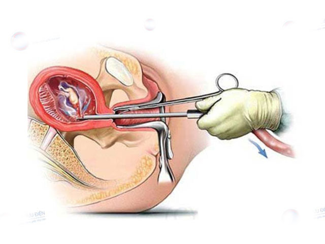 Phá Thai 5 Tuần Tuổi Ở Đâu An Toàn? Tư Vấn Bác Sĩ 4 Hút-thai-chân-không