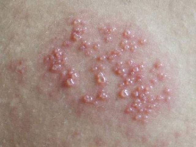 Nổi Mẩn Ngứa Vùng Kín Là Bệnh Gì? Nguyên Nhân & Cách Xử Lý Hiệu Quả 41 Mụn-rộp-sinh-dục