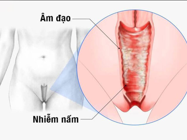 Nấm Âm Đạo Vùng Kín: Nguyên Nhân, Dấu Hiệu Và Cách Điều Trị Hiệu Quả
