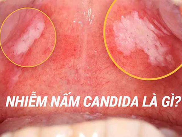 Nổi Mẩn Ngứa Vùng Kín Là Bệnh Gì? Nguyên Nhân & Cách Xử Lý Hiệu Quả 39 Nhiễm-nấm-Candida