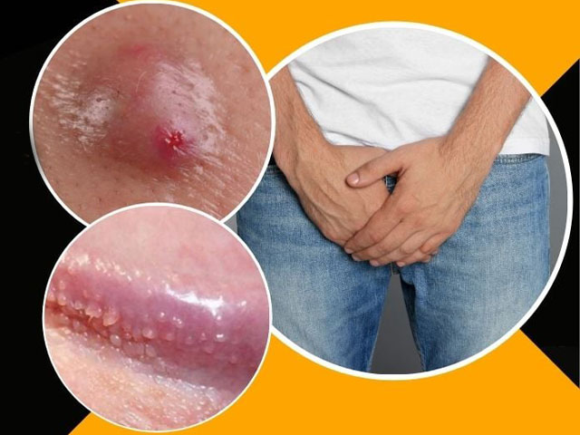 Nổi Mẩn Ngứa Vùng Kín Là Bệnh Gì? Nguyên Nhân & Cách Xử Lý Hiệu Quả