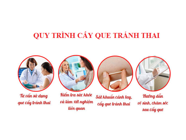 Cấy Que Tránh Thai Tại Hà Nội – Tư Vấn Bác Sĩ 4 Quy-trình-cấy-que-tránh-thai