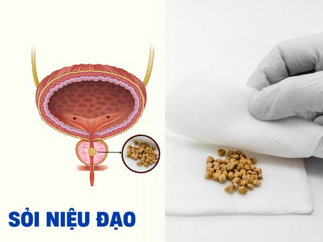 Tiểu Buốt, Tiểu Rát Có Phải Bệnh Niệu Đạo? 6 Sỏi-niệu-đạo