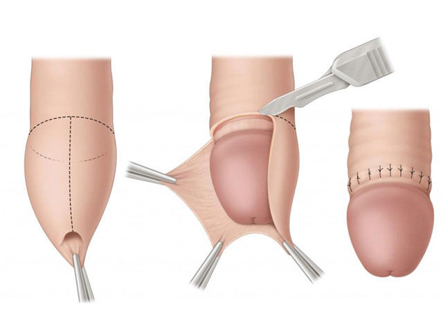 Phòng Khám Nam Học Hà Nội 52 Nguyễn Trãi 17 Tiểu-phẫu-bao-quy-đầu