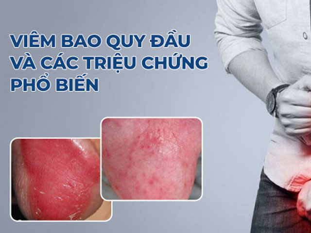 Nổi Mẩn Ngứa Vùng Kín Là Bệnh Gì? Nguyên Nhân & Cách Xử Lý Hiệu Quả 40 Viêm-bao-quy-đầu