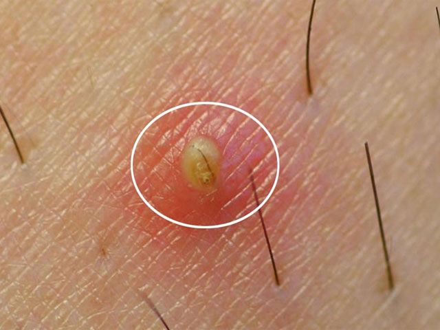 Nổi Mẩn Ngứa Vùng Kín Là Bệnh Gì? Nguyên Nhân & Cách Xử Lý Hiệu Quả 42 Viêm-nang-lông-vùng-kín