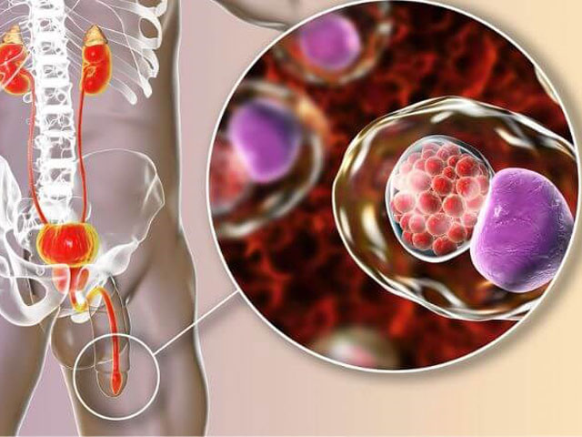 Tiểu Buốt, Tiểu Rát Có Phải Bệnh Niệu Đạo? 3 Viêm niệu đạo